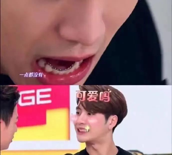 王嘉尔选择的也同样是舌侧矫正,不仅美观,还拥有和传统钢牙同样的效果