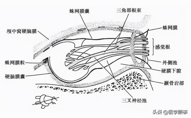 图-5 meckel腔图-6蛛网膜下隙与三叉神经节的关系meckel腔内的蛛网膜