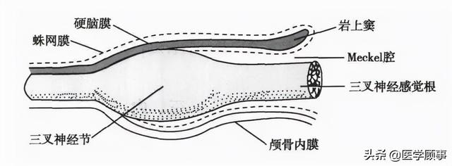 图-6蛛网膜下隙与三叉神经节的关系meckel腔内的蛛网膜下隙称三叉神经