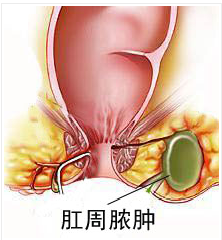 北京东大肛肠医院肛门有肉疙瘩不一定是痔疮