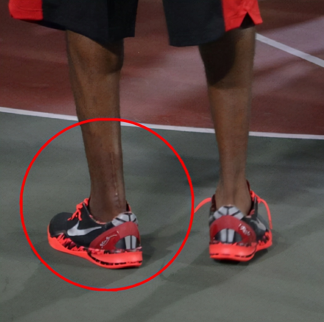 看了詹姆斯脚趾马龙白发罗斯膝盖你还羡慕nba球星高薪吗