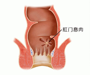 北京东大肛肠医院肛门有肉疙瘩不一定是痔疮