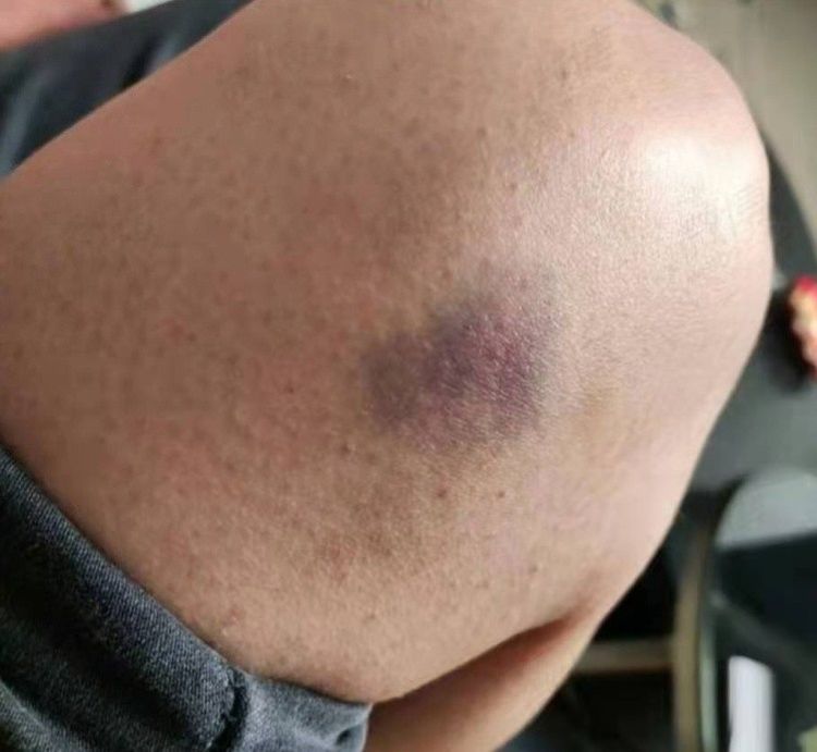 丑闻!山东泰山球员酒吧殴打女生,受害者遍体鳞伤,警方介入调查休闲区蓝鸢梦想 - Www.slyday.coM 丑闻!山东泰山球员酒吧殴打女生,受害者遍体鳞伤,警方介入调查休闲区蓝鸢梦想 - Www.slyday.coM