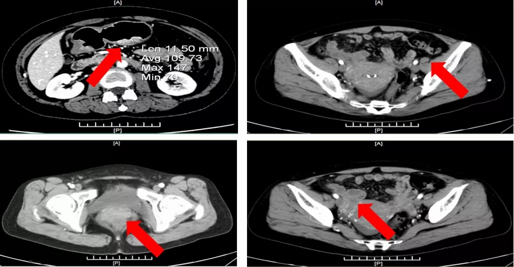 维迪西妥单抗为her2ihc2晚期胃癌患者带来治疗新契机