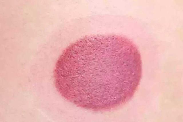 3,颜色发红,但是比较暗,表示血脂比较高,且有热症.