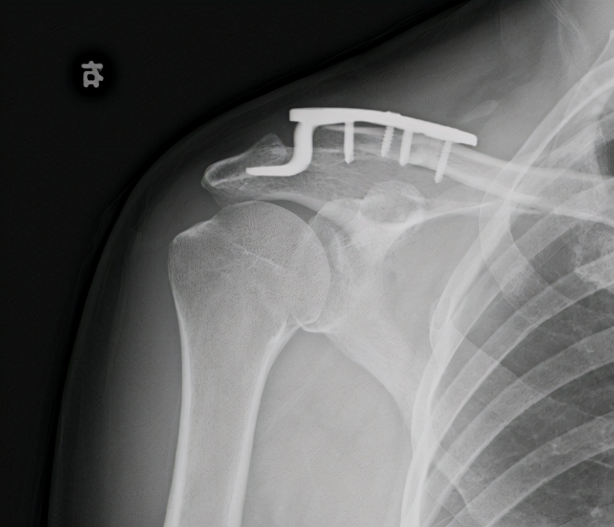 男子车祸致肩锁关节脱位微创手术复位快速康复