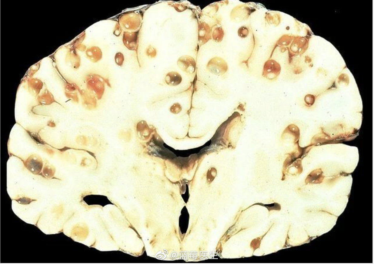 猪带绦虫的幼虫引起的囊尾蚴病大量的囊状出现在脑部