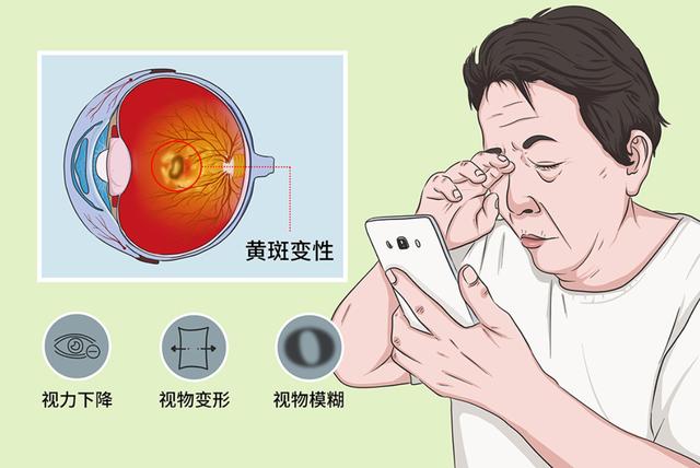 视力下降误当白内障,延误治疗10年近失明,长沙爷爷好后悔|爱尔眼科