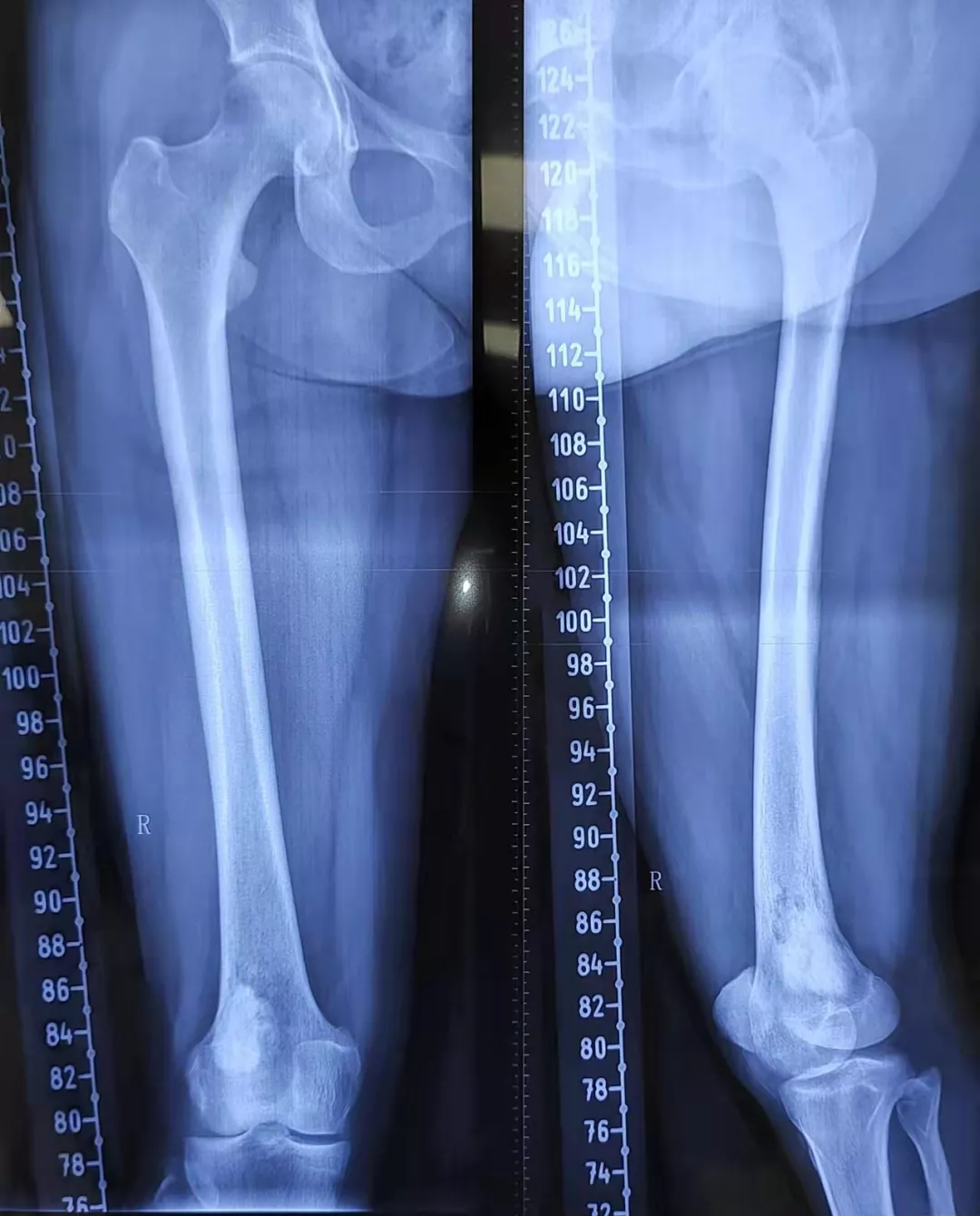 在当地医院检查发现右股骨下段出现病变,诊断为恶性骨源性肿瘤