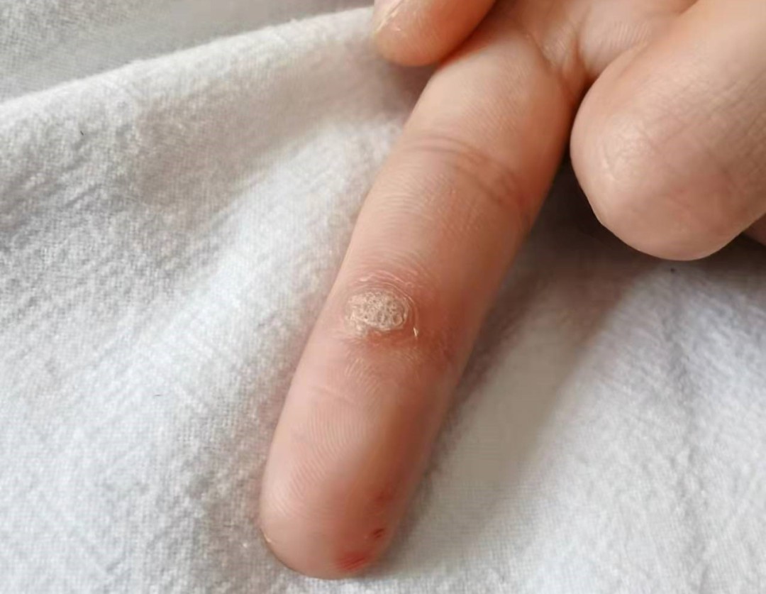 这些地方长"小疙瘩",可能诱发癌变|hpv_新浪新闻