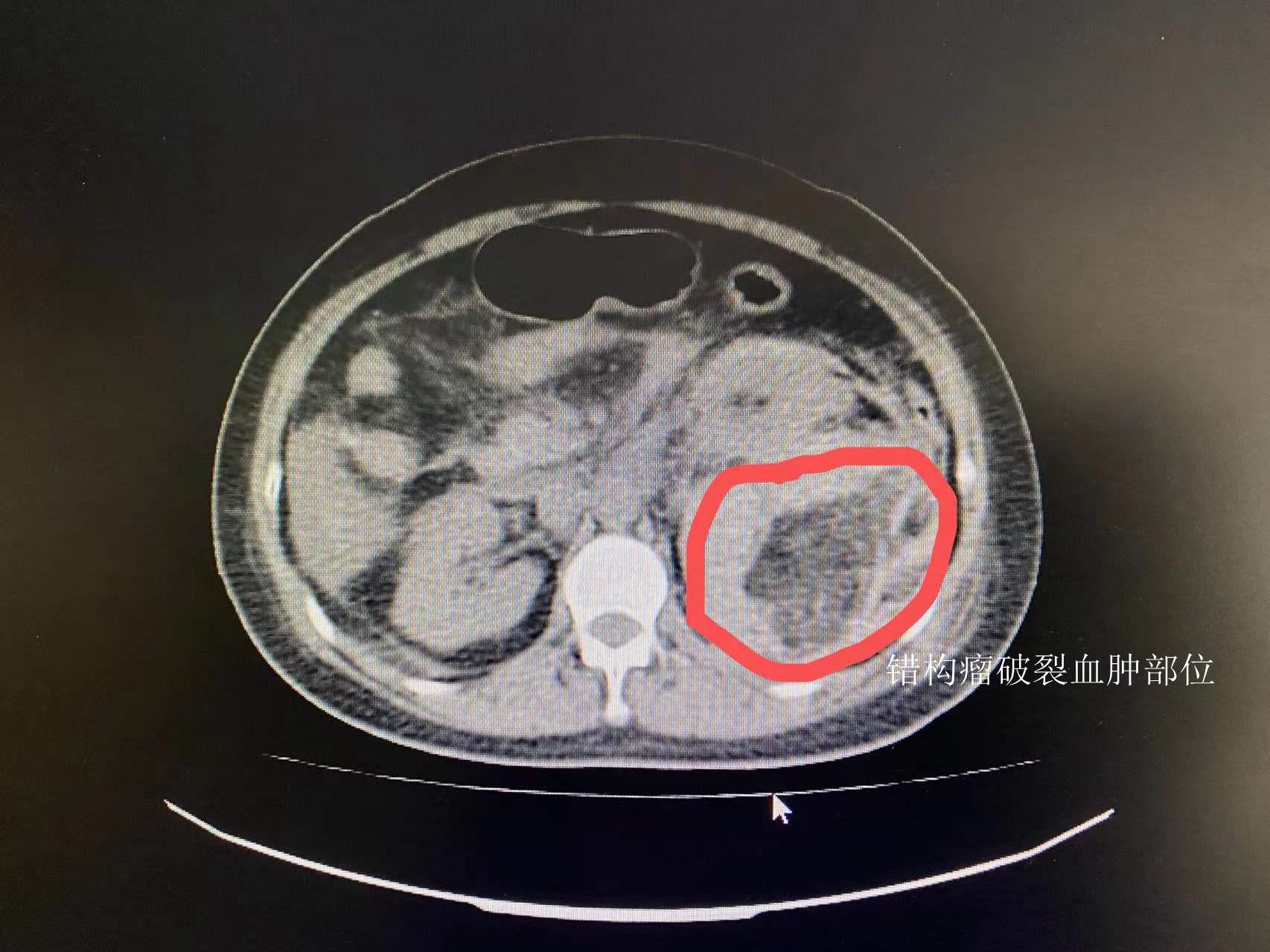 当地医院就诊,经ct检查发现李女士左肾出血,考虑为左肾错构瘤破裂出血