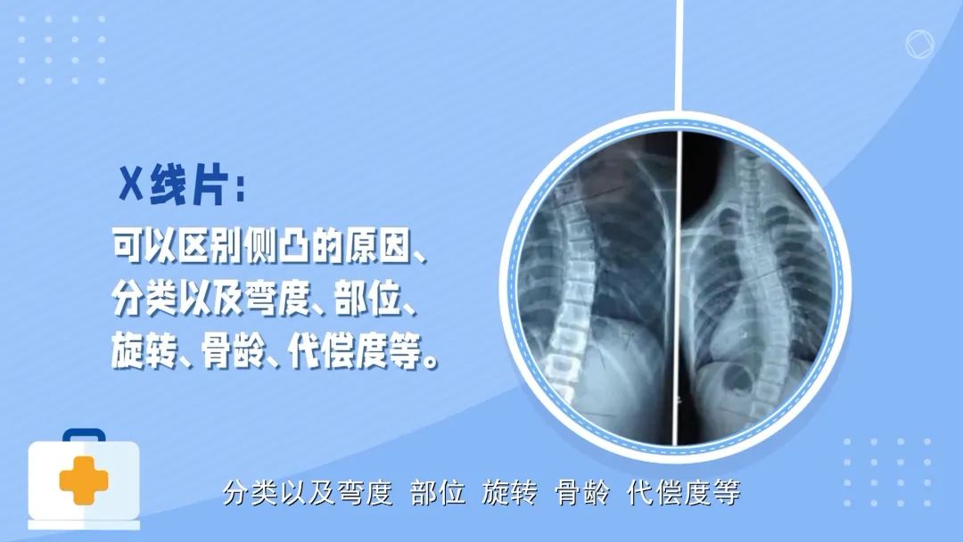 科普八桂中医大讲堂10什么是青少年特发性脊柱侧弯