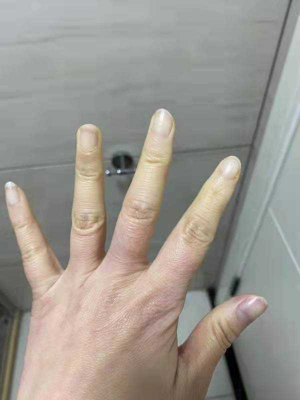 警惕天凉手指发白不是好事