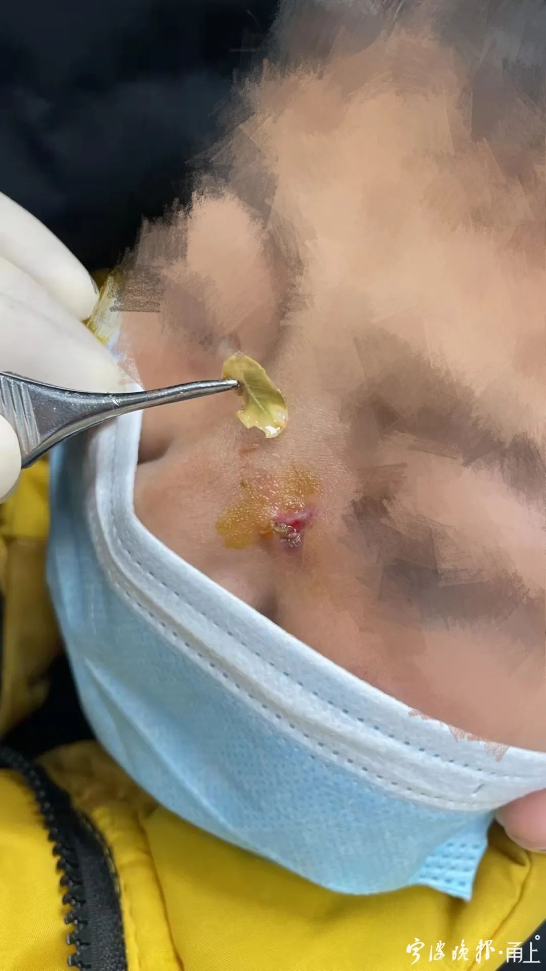 大案告破爸爸不惜砸10万给儿子割肉结果竟是一片树叶在捣鬼