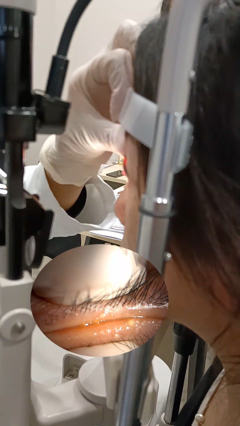 真实的睑板腺按摩案例分享