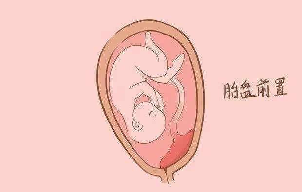 胎盘覆盖宫颈内口图片