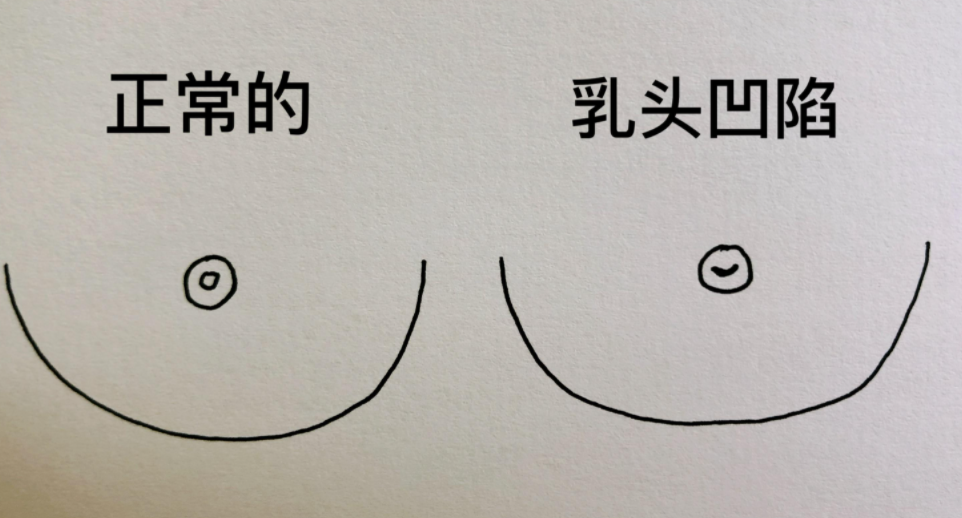 往往与3个因素相关,及时远离,保护乳腺健康|乳腺癌|乳腺|乳头_新浪