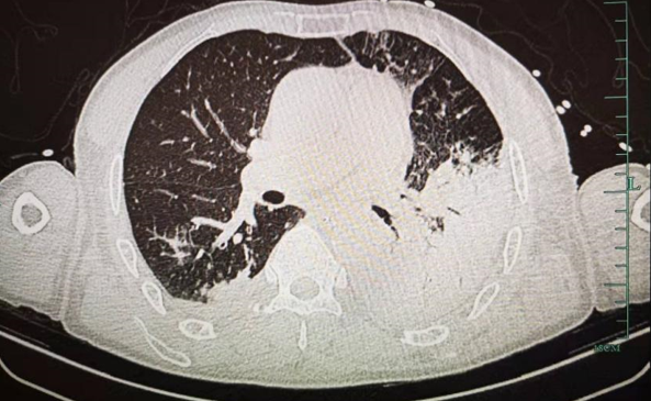 大爷用鸡粪施肥结果感染重症肺炎住进icu专家节前提醒接触禽类要注意