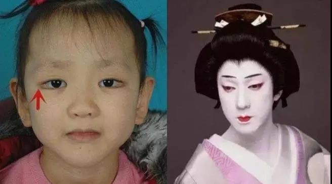 歌舞伎脸谱症症状图片