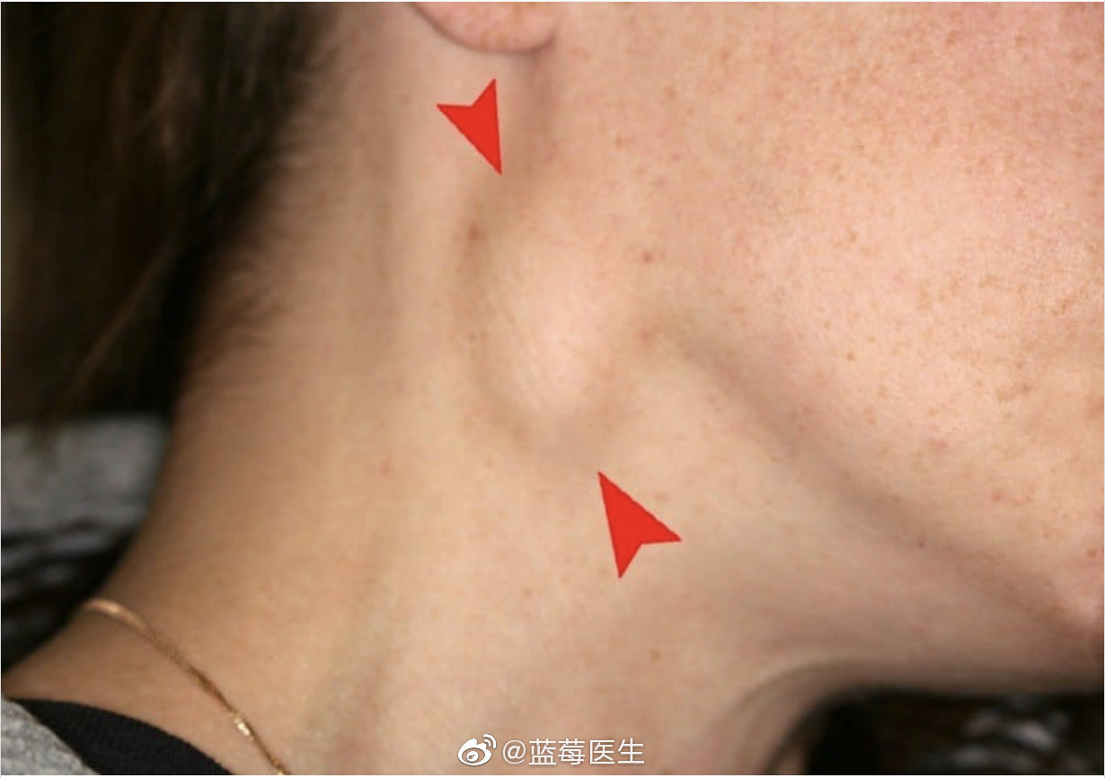 下颌结节位置图片图片