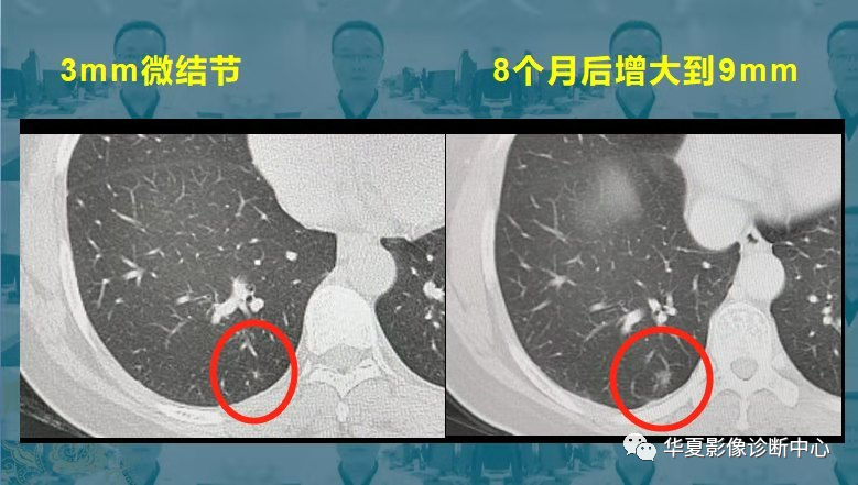 磨玻璃肺結節隨訪觀察會不會變成肺癌帶你看隨訪4種結局