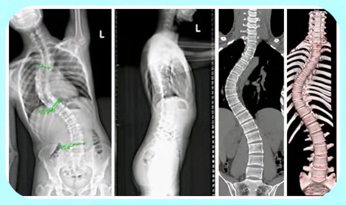 由于脊柱的弯曲(特别是胸椎弯曲),有可能导致胸廓的变形,由于心脏以及