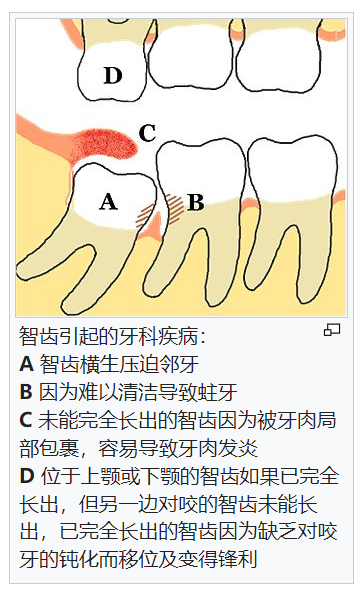 年度征文你的智齿还要留着过几个年