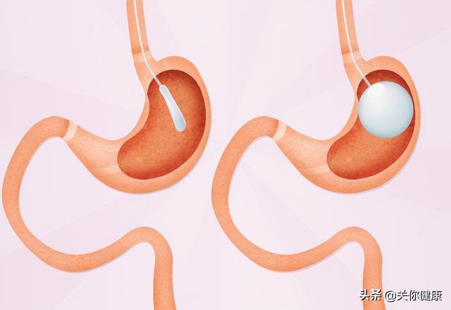 胃里放个球囊就能够彻底减肥吗会带来健康风险吗