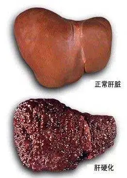 5种方法预防肝硬化|病毒性肝炎|肝硬化|肝病_新浪新闻