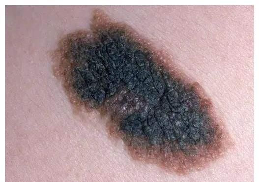 盘点7种常见的宝宝胎记这2种不用管剩下5种需要干预