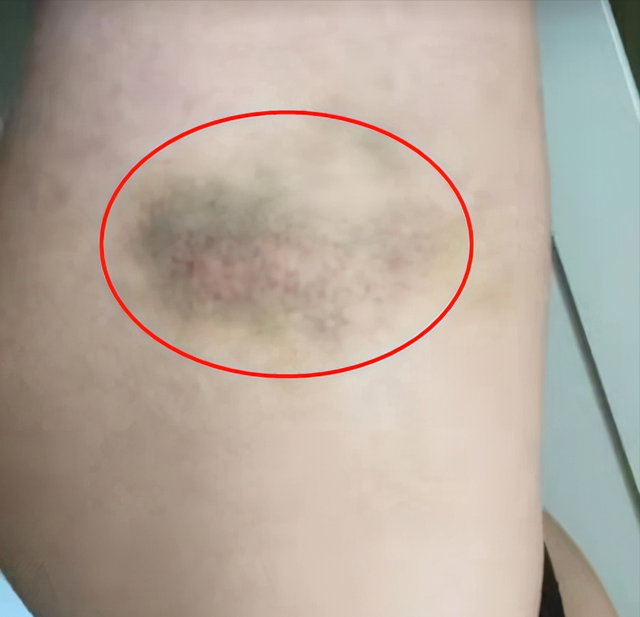 "家暴",从他女友晒出的图片来看,嘴角流血,身上多处有淤青的伤痕