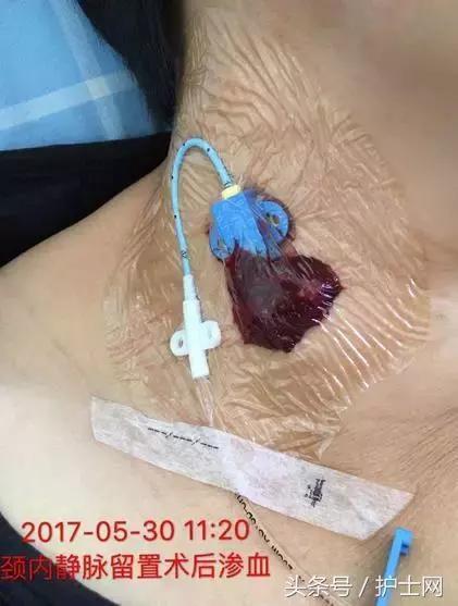 敷料|敷贴|导管_新浪新闻