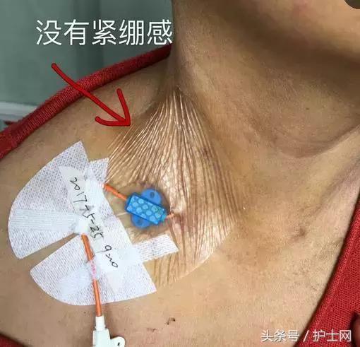 提醒:颈内静脉敷帖更换时,最好根据患者颈部的长短来选择大小合适的