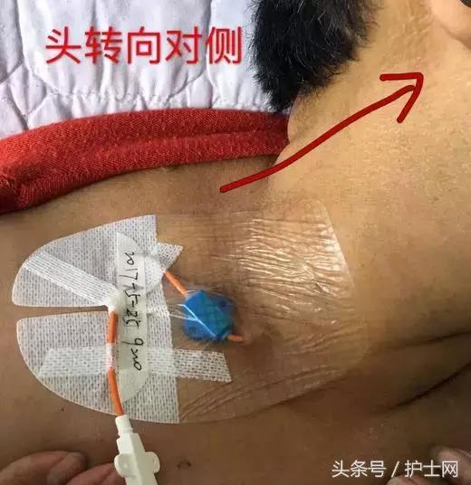 提醒:颈内静脉敷帖更换时,最好根据患者颈部的长短来选择大小合适的
