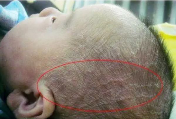 有一种"坑娃"行为叫抠乳痂,看似对娃好,实则会让