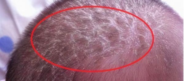 有一种"坑娃"行为叫抠乳痂,看似对娃好,实则会让