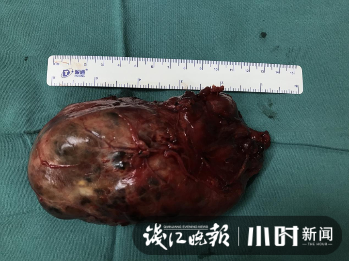 安分了十几年的肿瘤突然变大十多倍，到医院一检查，个头比甜瓜还要大休闲区蓝鸢梦想 - Www.slyday.coM