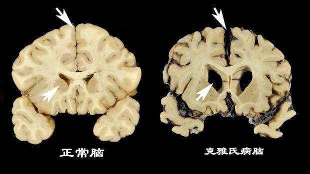 恐怖的库鲁病致死率100竟是当地土著分食同类遗体导致的