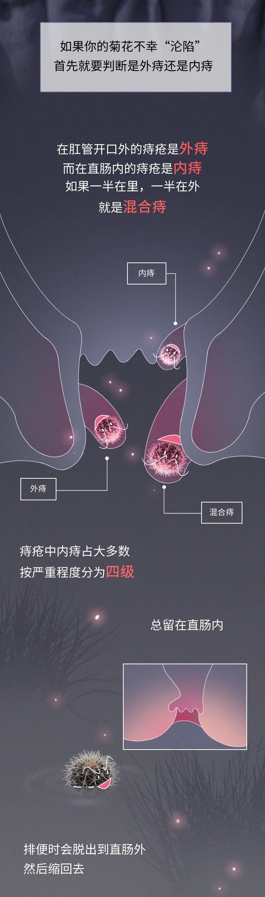 痔疮是怎么跑到你的菊花里的
