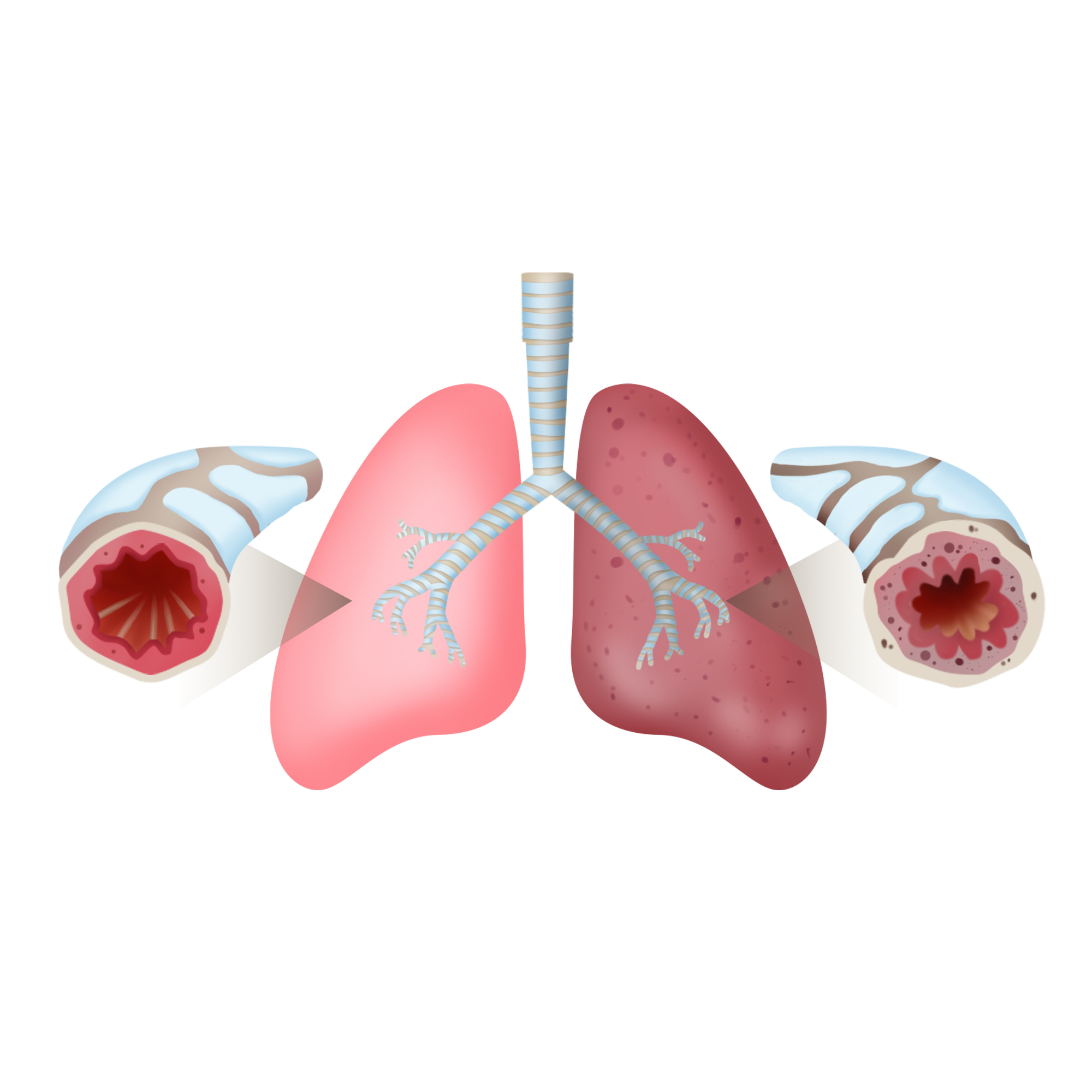 出现这些症状小心宝宝支气管炎