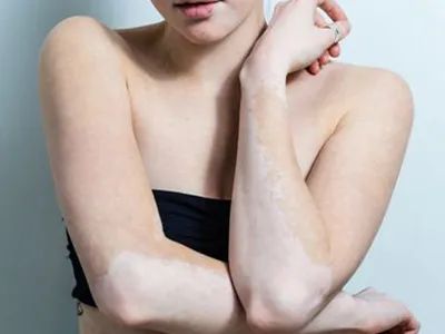 白癜风会传染,遗传吗?|白癜风|皮肤病|病原体_新浪新闻