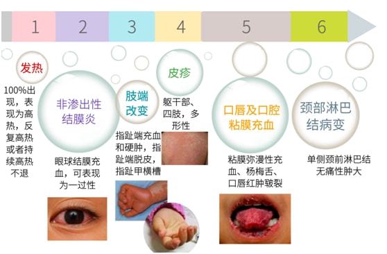 小儿推拿杨晓什么是小儿川崎病有哪些症状如何诊断和护理