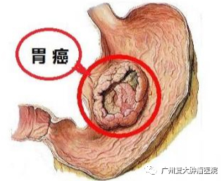 河北肿瘤医院请选择广州复大肿瘤医院:胃癌常见的高危因素有哪些