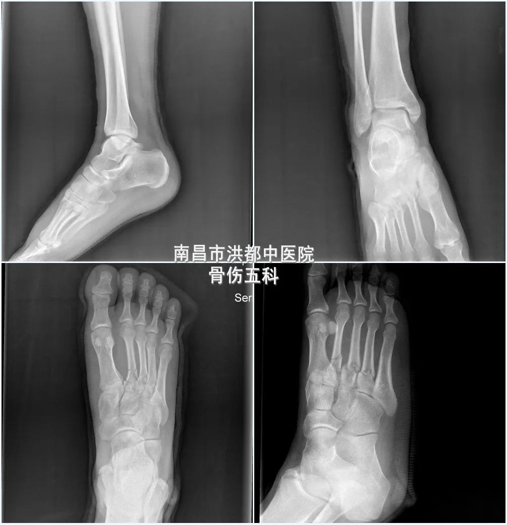 整复后当时复查x光片显示骨折处对位对线可骨伤五科医生先为张先生