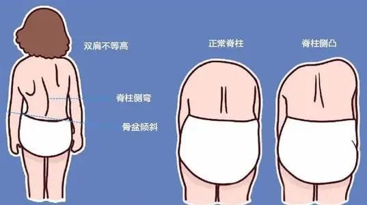 小儿推拿杨晓儿童脊柱侧弯危害大要早预防早发现早治疗