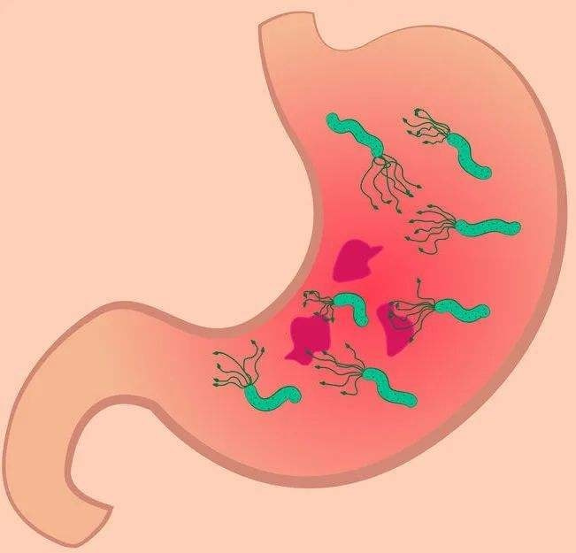 小儿推拿杨晓：儿童感染幽门螺杆菌的原因症状？需不需要检测治疗休闲区蓝鸢梦想 - Www.slyday.coM