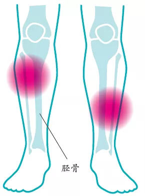 跑步时为什么小腿疼痛?可能是伤了胫骨!|跑步_新浪新闻