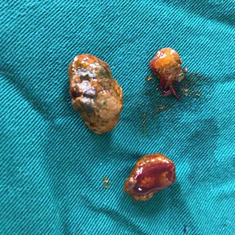 健康随行|泌尿系结石疼起来真"要命",权威医生来支招!