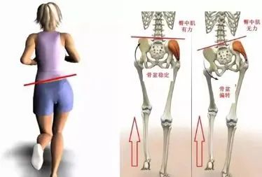 从而造成长短腿,高低肩,而出现骨盆旋移
