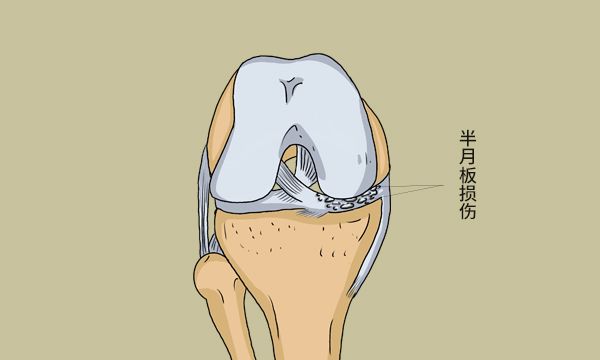 半月板撕裂后,总是疼痛难忍,怎么办?还有办法修复吗?
